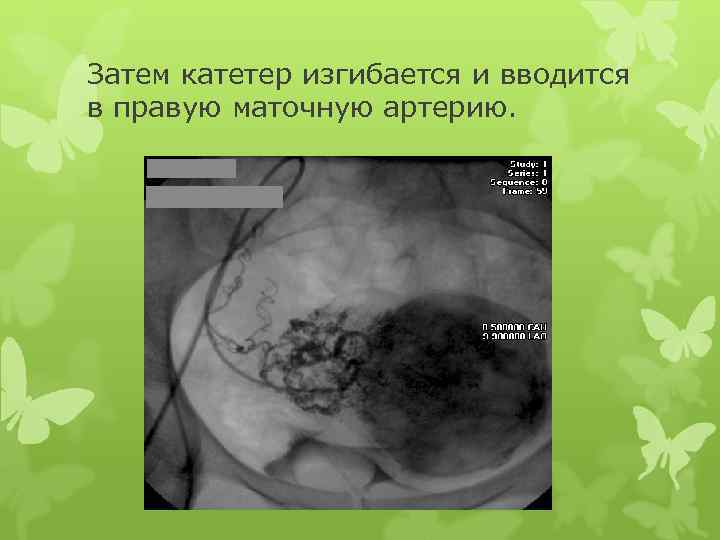 Затем катетер изгибается и вводится в правую маточную артерию. 
