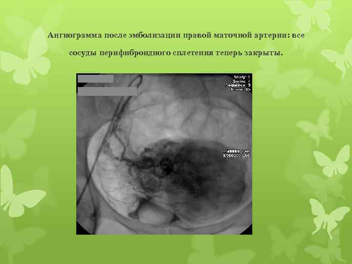 Ангиограмма после эмболизации правой маточной артерии: все сосуды перифиброидного сплетения теперь закрыты. 