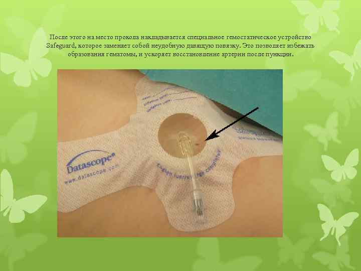 После этого на место прокола накладывается специальное гемостатическое устройство Safeguard, которое заменяет собой неудобную