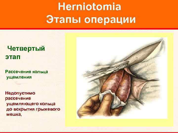 Herniotomia Этапы операции Четвертый этап Рассечение кольца ущемления Недопустимо рассечение ущемляющего кольца до вскрытия