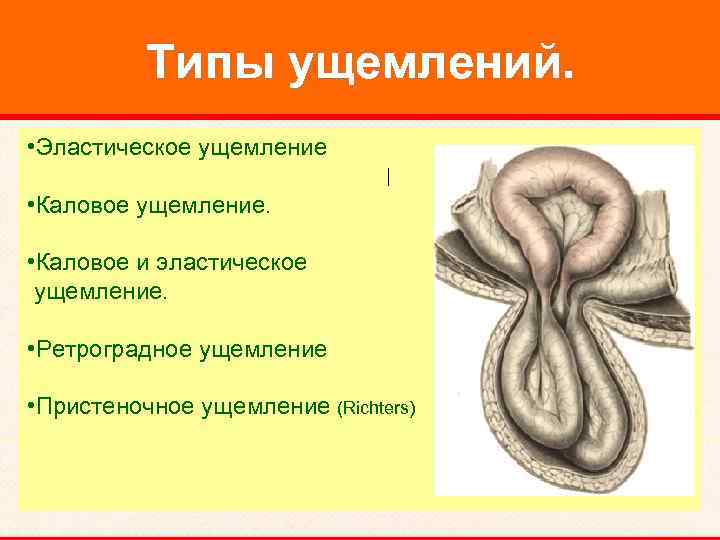 Типы ущемлений. • Эластическое ущемление • Каловое ущемление. • Каловое и эластическое ущемление. •