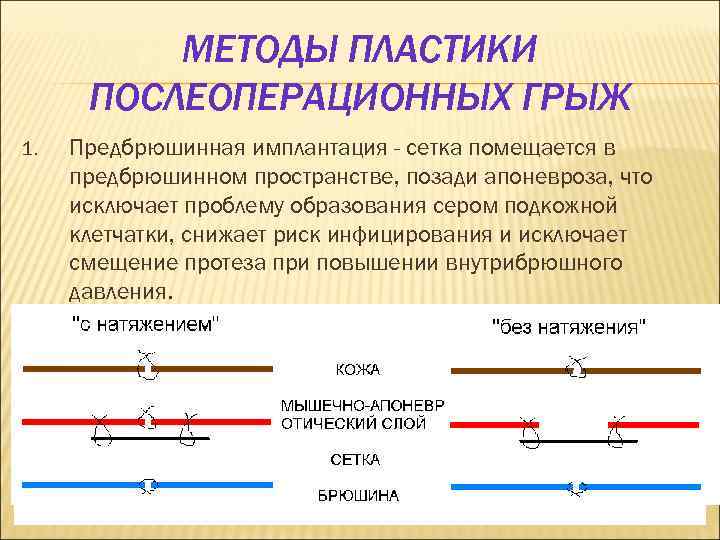 МЕТОДЫ ПЛАСТИКИ ПОСЛЕОПЕРАЦИОННЫХ ГРЫЖ 1. Предбрюшинная имплантация - сетка помещается в предбрюшинном пространстве, позади