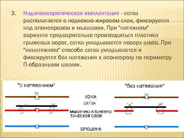 3. Надапоневротическая имплантация - сетка располагается в подкожно-жировом слое, фиксируется над апоневрозом и мышцами.