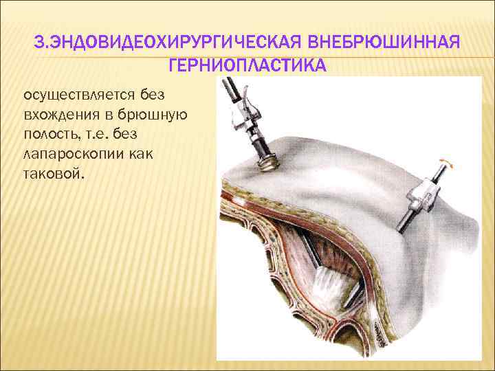 3. ЭНДОВИДЕОХИРУРГИЧЕСКАЯ ВНЕБРЮШИННАЯ ГЕРНИОПЛАСТИКА осуществляется без вхождения в брюшную полость, т. е. без лапароскопии
