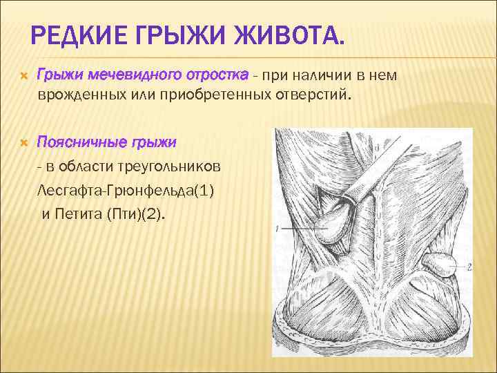 РЕДКИЕ ГРЫЖИ ЖИВОТА. Грыжи мечевидного отростка - при наличии в нем врожденных или приобретенных