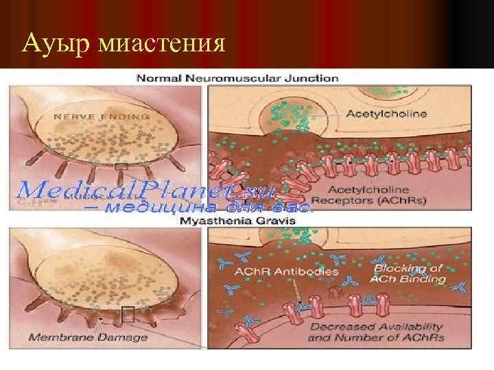 Ауыр миастения 