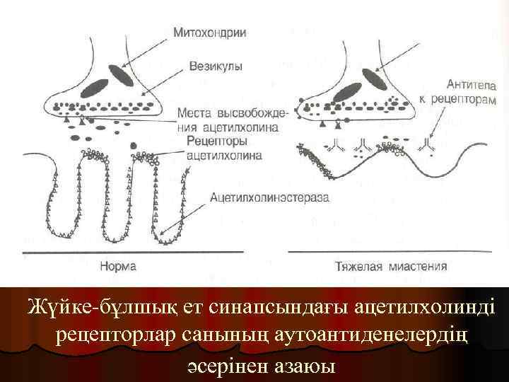 Жүйке-бұлшық ет синапсындағы ацетилхолинді рецепторлар санының аутоантиденелердің әсерінен азаюы 