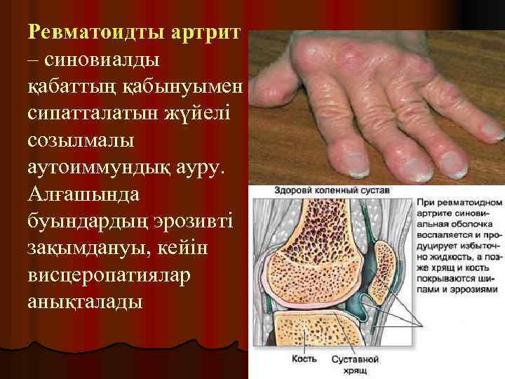 Ревматоидты артрит – синовиалды қабаттың қабынуымен сипатталатын жүйелі созылмалы аутоиммундық ауру. Алғашында буындардың эрозивті