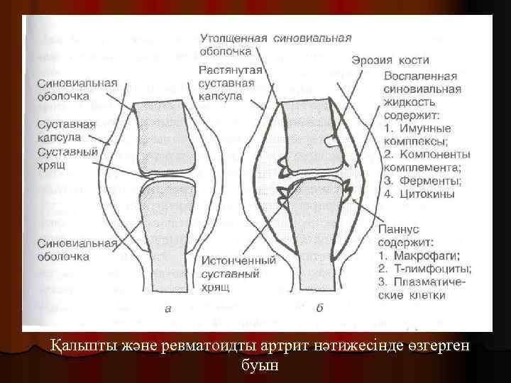 Қалыпты және ревматоидты артрит нәтижесінде өзгерген буын 