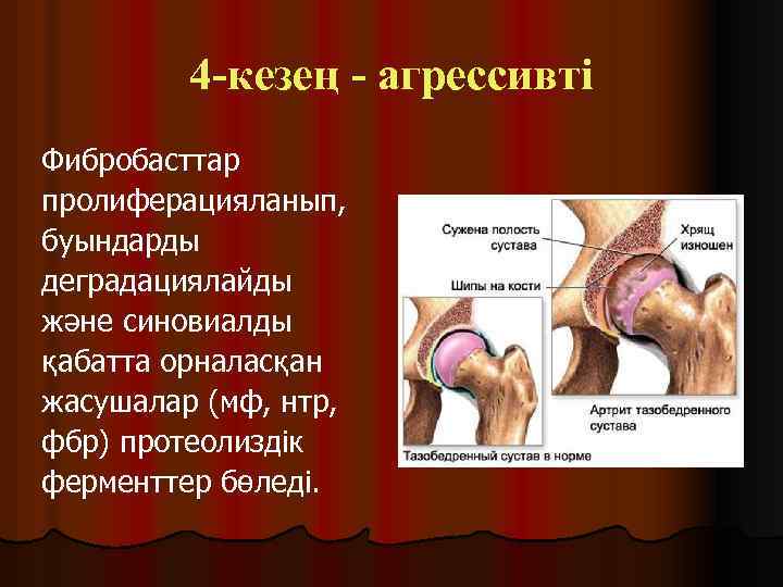 4 -кезең - агрессивті Фибробасттар пролиферацияланып, буындарды деградациялайды және синовиалды қабатта орналасқан жасушалар (мф,