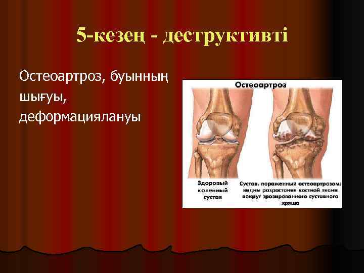 5 -кезең - деструктивті Остеоартроз, буынның шығуы, деформациялануы 