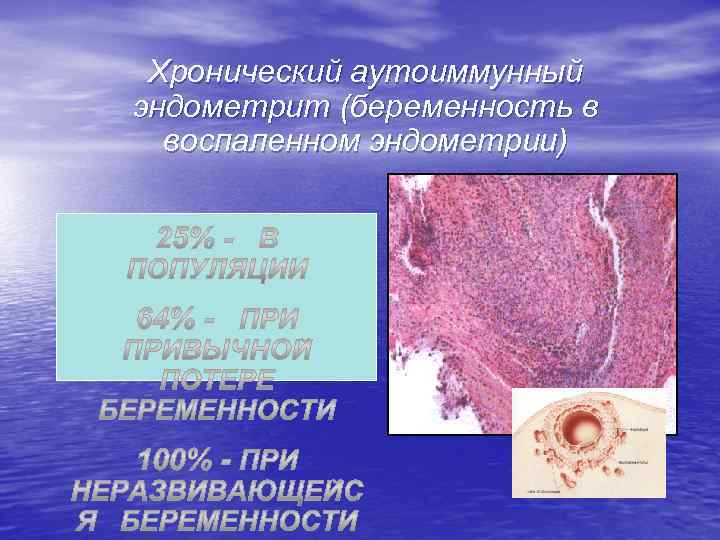 Хронический аутоиммунный эндометрит (беременность в воспаленном эндометрии) 