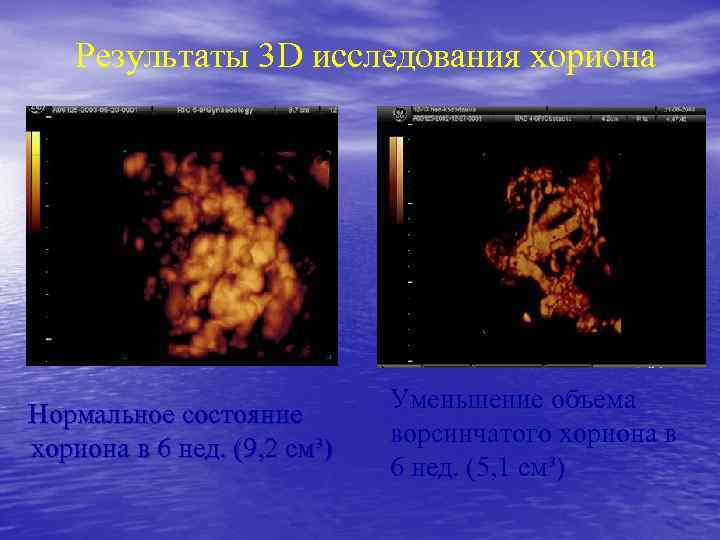 Результаты 3 D исследования хориона Нормальное состояние хориона в 6 нед. (9, 2 см³)