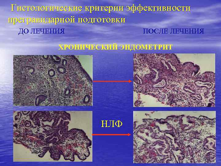 Гистологические критерии эффективности прегравидарной подготовки ДО ЛЕЧЕНИЯ ПОСЛЕ ЛЕЧЕНИЯ ХРОНИЧЕСКИЙ ЭНДОМЕТРИТ НЛФ 