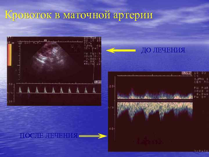 Кровоток в маточной артерии ДО ЛЕЧЕНИЯ ПОСЛЕ ЛЕЧЕНИЯ 