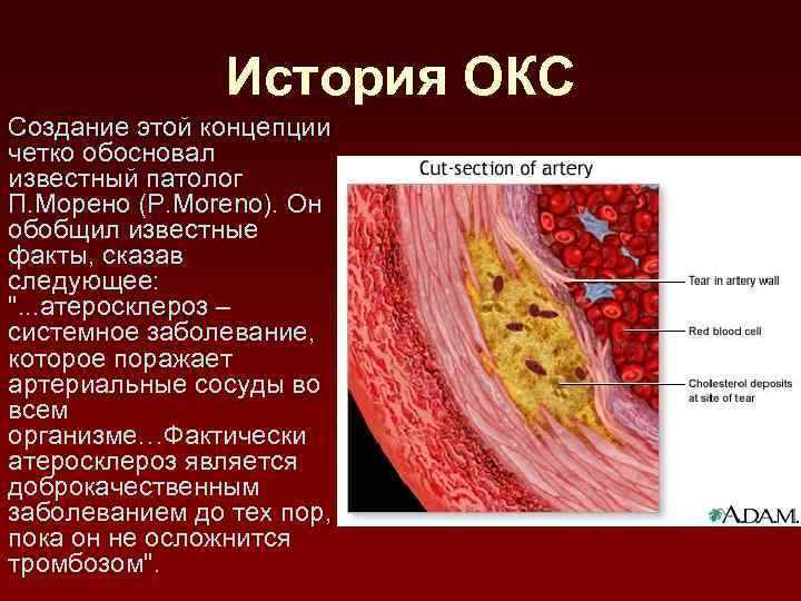 История ОКС Создание этой концепции четко обосновал известный патолог П. Морено (P. Moreno). Он