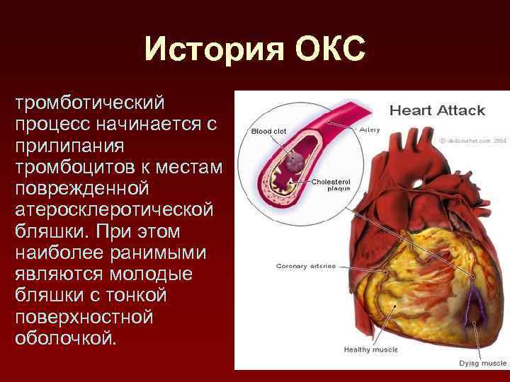 История ОКС тромботический процесс начинается с прилипания тромбоцитов к местам поврежденной атеросклеротической бляшки. При