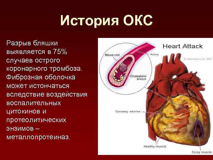 История ОКС Разрыв бляшки выявляется в 75% случаев острого коронарного тромбоза. Фиброзная оболочка может