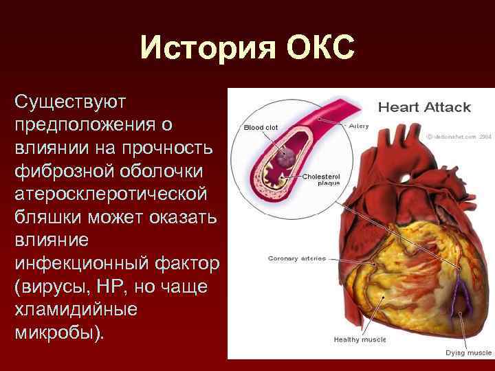 История ОКС Существуют предположения о влиянии на прочность фиброзной оболочки атеросклеротической бляшки может оказать