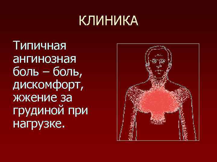 КЛИНИКА Типичная ангинозная боль – боль, дискомфорт, жжение за грудиной при нагрузке. 