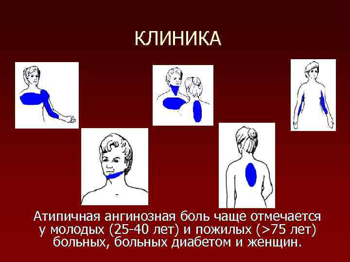 КЛИНИКА Атипичная ангинозная боль чаще отмечается у молодых (25 -40 лет) и пожилых (>75