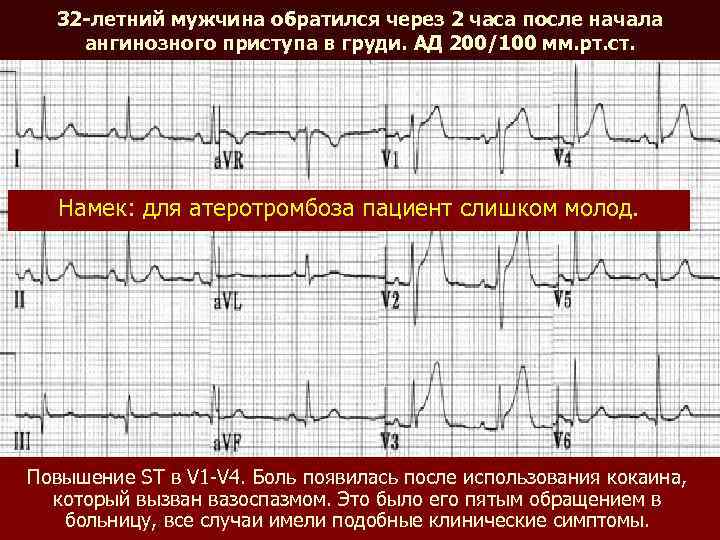 32 -летний мужчина обратился через 2 часа после начала ангинозного приступа в груди. АД