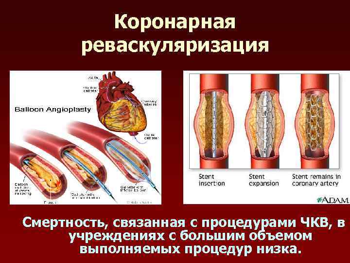 Коронарная реваскуляризация Смертность, связанная с процедурами ЧКВ, в учреждениях с большим объемом выполняемых процедур