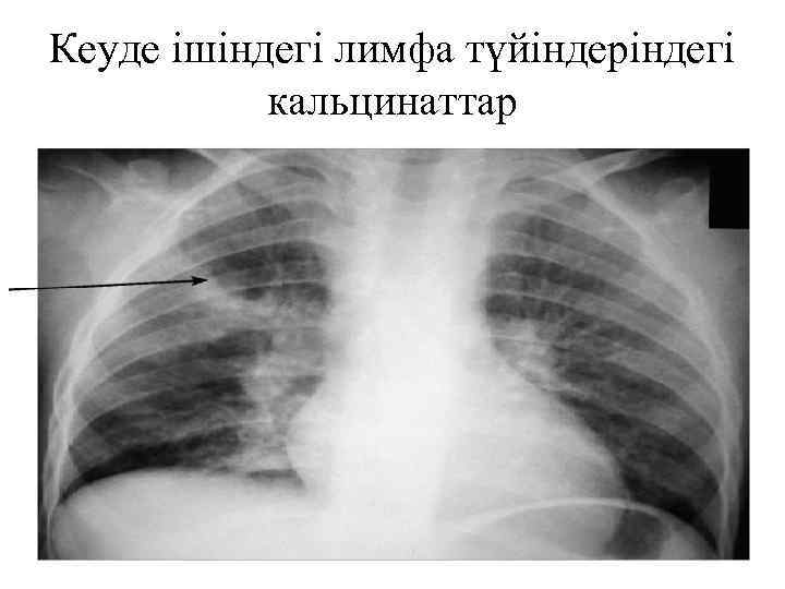 Кеуде ішіндегі лимфа түйіндеріндегі кальцинаттар 