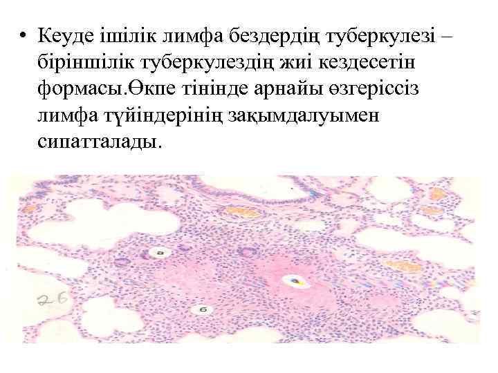  • Кеуде ішілік лимфа бездердің туберкулезі – біріншілік туберкулездің жиі кездесетін формасы. Өкпе