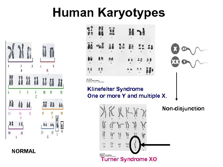 Human Karyotypes Klinefelter Syndrome One or more Y and multiple X. Non-disjunction NORMAL Turner