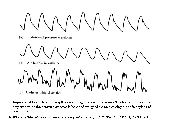 Figure 7. 14 Distortion during the recording of arterial pressure The bottom trace is