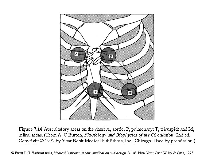 Figure 7. 16 Auscultatory areas on the chest A, aortic; P, pulmonary; T, tricuspid;
