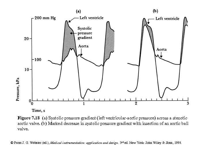 Figure 7. 18 (a) Systolic pressure gradient (left ventricular-aortic pressure) across a stenotic aortic