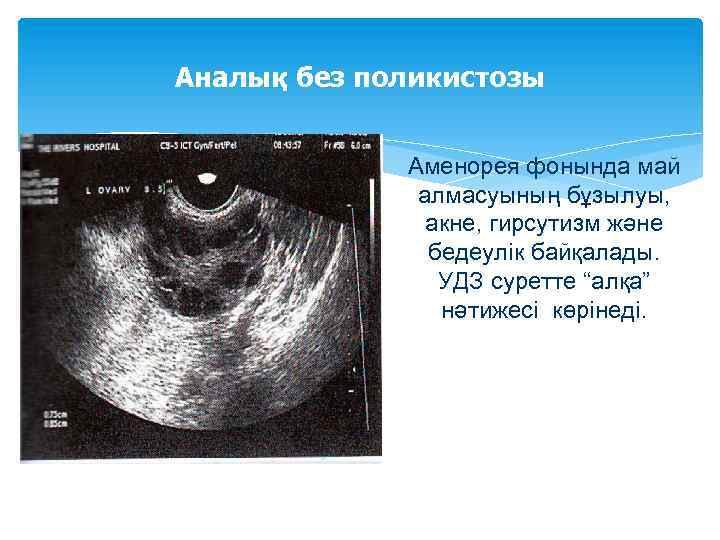 Аналық без поликистозы Аменорея фонында май алмасуының бұзылуы, акне, гирсутизм және бедеулік байқалады. УДЗ