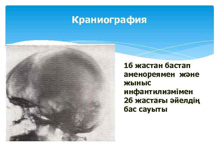 Краниография 16 жастан бастап аменореямен және жыныс инфантилизмімен 26 жастағы әйелдің бас сауыты 