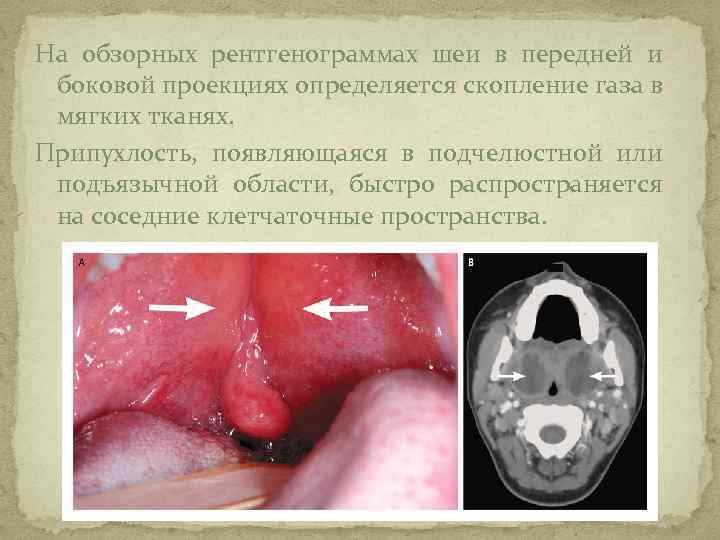 Характерной особенностью клинической картины ангины людвига является