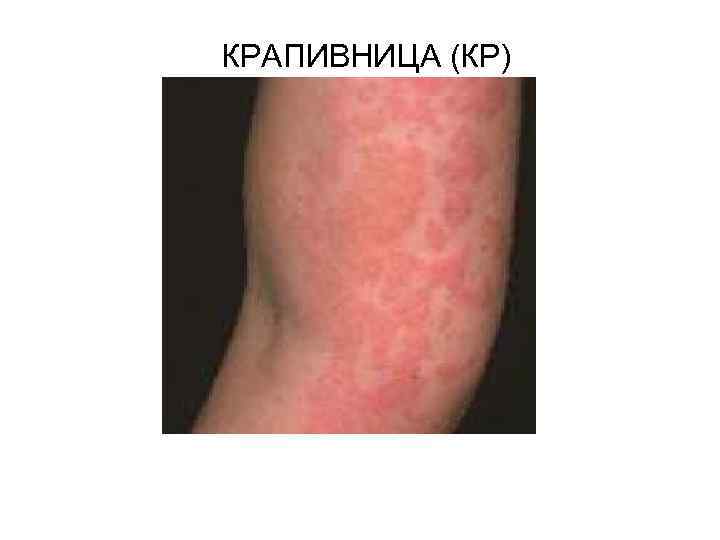  КРАПИВНИЦА (КР) 