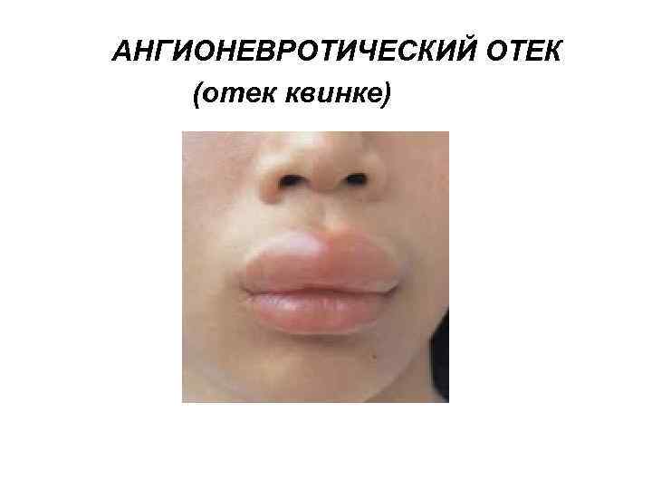  АНГИОНЕВРОТИЧЕСКИЙ ОТЕК (отек квинке) 