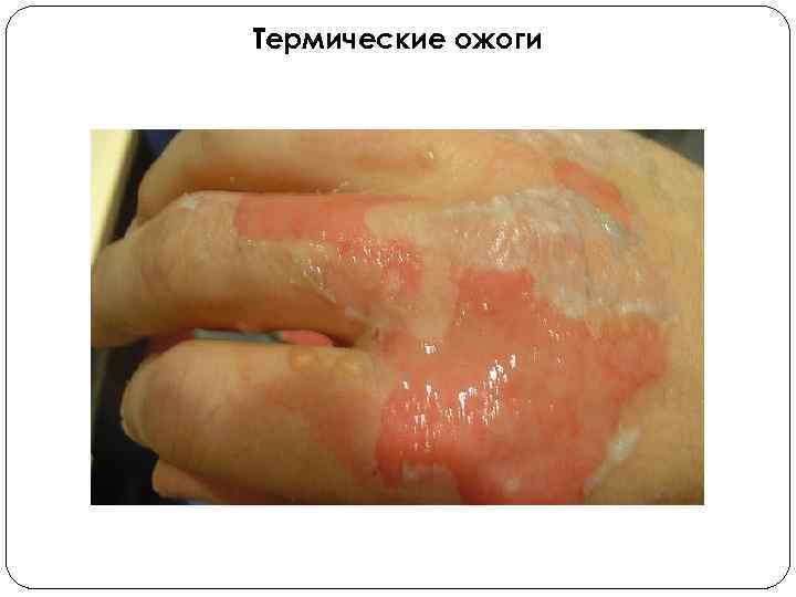 Термические ожоги 