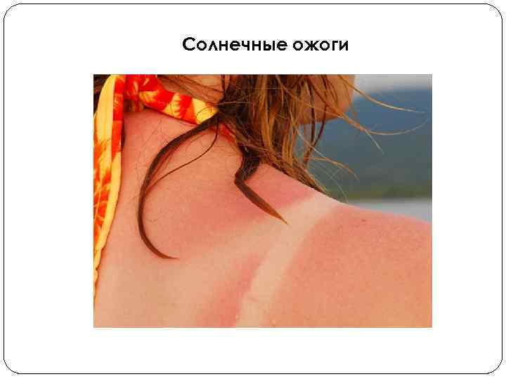 Солнечные ожоги 
