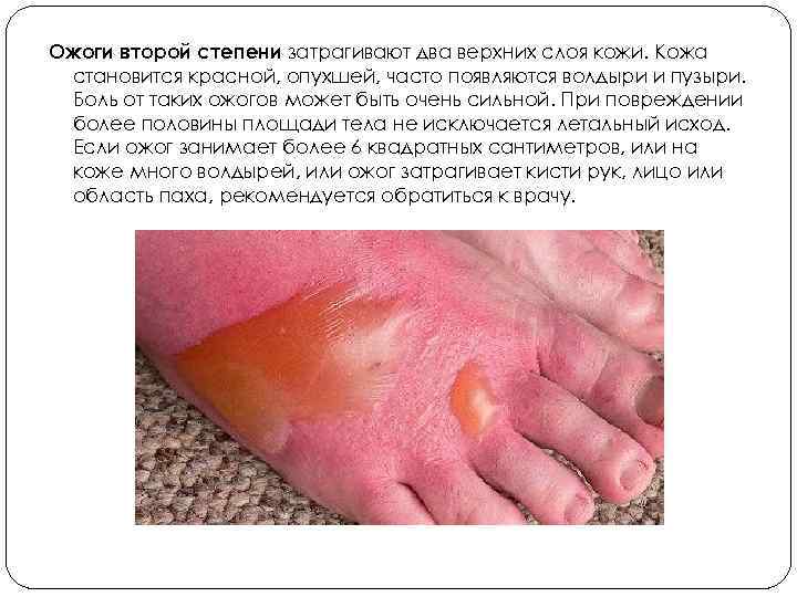 Ожоги второй степени затрагивают два верхних слоя кожи. Кожа становится красной, опухшей, часто появляются