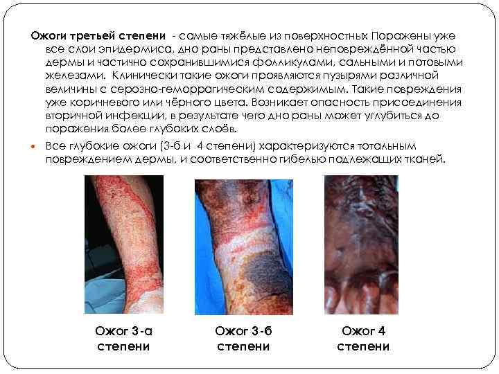 Ожоги третьей степени - самые тяжёлые из поверхностных Поражены уже все слои эпидермиса, дно