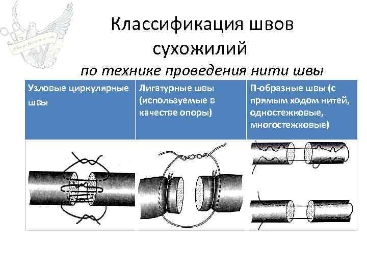 Классификация швов сухожилий по технике проведения нити швы Узловые циркулярные Лигатурные швы (используемые в