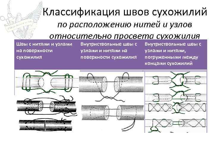 Виды хирургических швов презентация