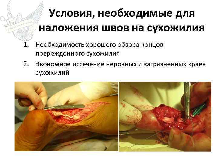 Условия, необходимые для наложения швов на сухожилия 1. Необходимость хорошего обзора концов поврежденного сухожилия