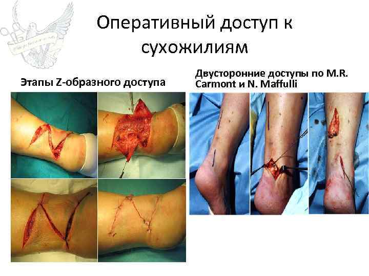 Оперативный доступ к сухожилиям Этапы Z-образного доступа Двусторонние доступы по M. R. Carmont и