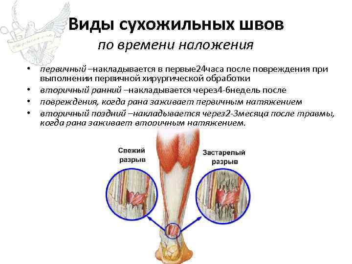 Виды сухожильных швов по времени наложения • первичный –накладывается в первые 24 часа после