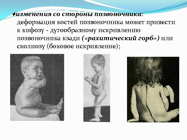 ♦изменения со стороны позвоночника: деформация костей позвоночника может привести к кифозу дугообразному искривлению позвоночника