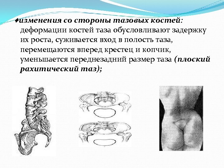♦изменения со стороны тазовых костей: деформации костей таза обусловливают задержку их роста, суживается вход