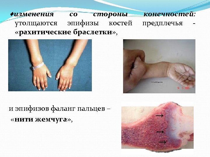♦изменения со стороны утолщаются эпифизы костей «рахитические браслетки» , и эпифизов фаланг пальцев –